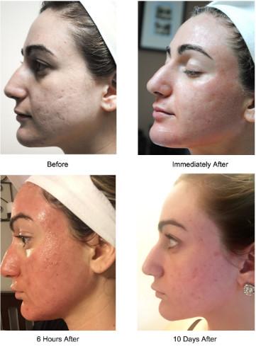 Salon CO2 Fractional Laser Machine Vaginal Tightening Skin Resurfacing Beauty Equipment