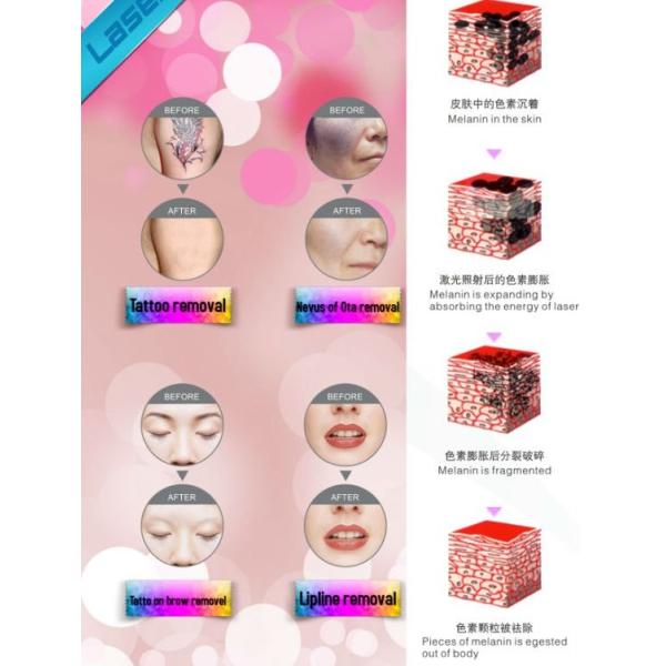 tatoo removal nd yag laser,portable q switched nd yag laser beauty machine price