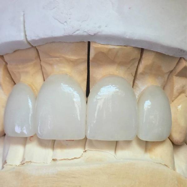 Кроны Zirconia прочности тела восстановление тонкой прочное естественное реалистическое