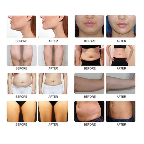 Newangie Nouvelle Arrivée Cryo 360 Cryolipolyse Élimination des Graisses Cryothérapie Machine Minceur Cryolipolyse