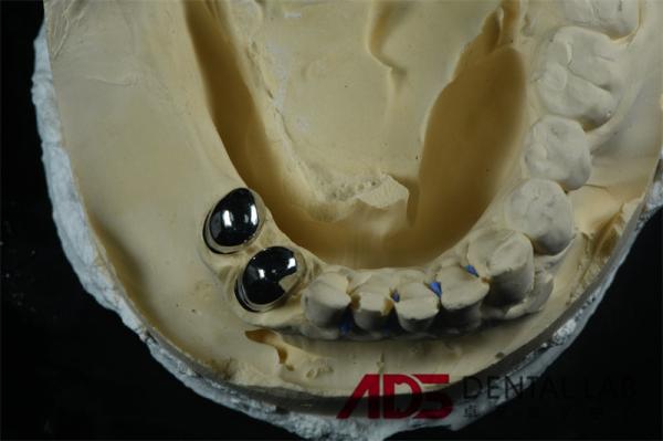 Custom Metal precision Attachment Partial Denture Telescoper