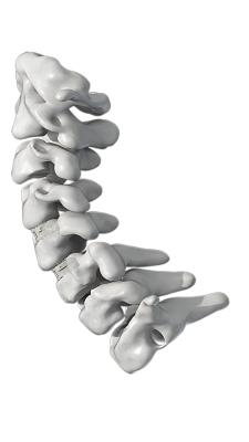 ISO PEEK Spinal Fusion Cage Degenerative Disc Disease Cervical Fusion Cage