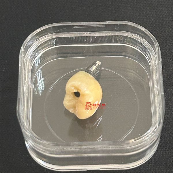 Customized Dental Crown and Implant with CE FDA Certification Using 3D Laser Printing Technology
