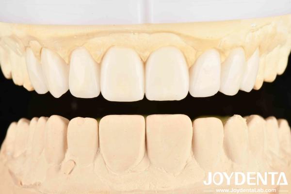 Dental's Good Elasticity And Tooth Arrangement Technology Flexible Denture Finish In Dental Care