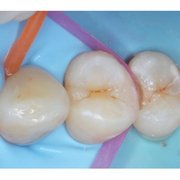 Band Dental Sectional Matrix System Resin Finishing Polishing Strips Roll Band