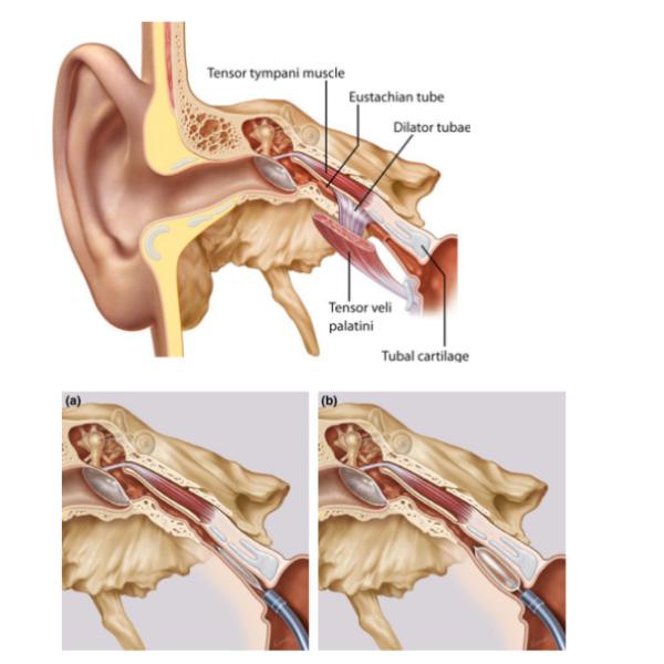 Balão Eustachian Tuboplasty da pressão da orelha da APOSTA do tubo auditivo para Clinial