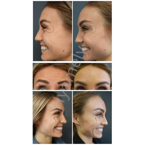 Botulinum тип впрыски Hyamely Botox 100IU токсина a сморщивает BTX впрыски удаления