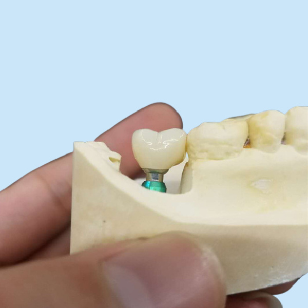 Ультра трудная крона зубного имплантата OEM стабильности цвета легкая поддерживает