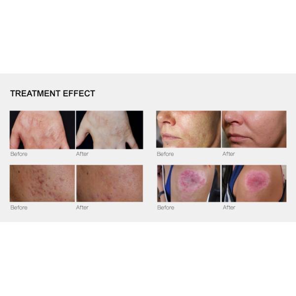 Cellashape Dual Frequency RF Microneedle Machine Skin Rejuvenation