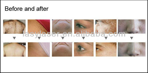 Elight SHR Pico Tattoo Removal Machine 220V Portable Nd Yag Laser