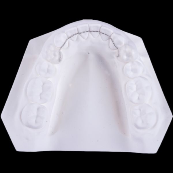 Non Removable Lingual Wire Retainer Orthodontics Retainers To Straighten Teeth