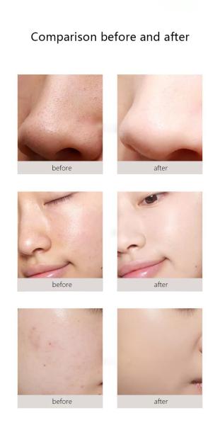 Facial Pdt Light Oxygen Therapy Machine Micro Current , 250W Jet Peel Facial Machine