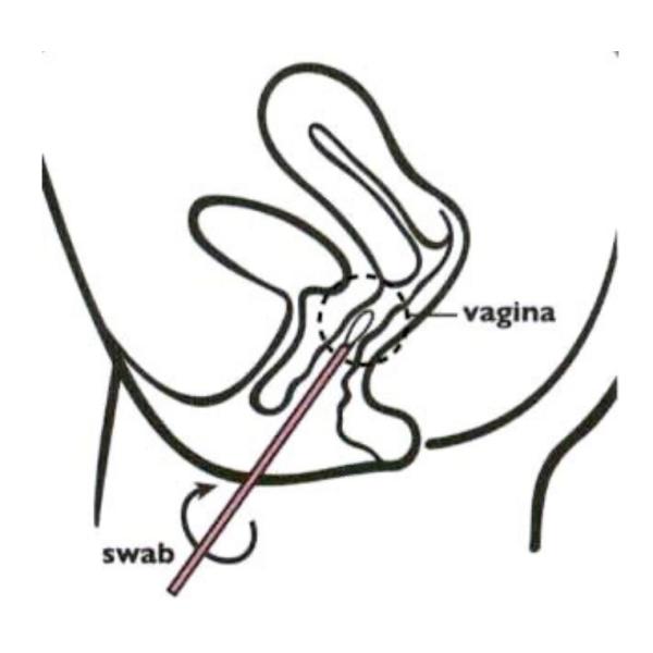 Кассета диагностического теста триппера шага высокой точности одного быстрая, метод золота коллоидный, легко и быстро