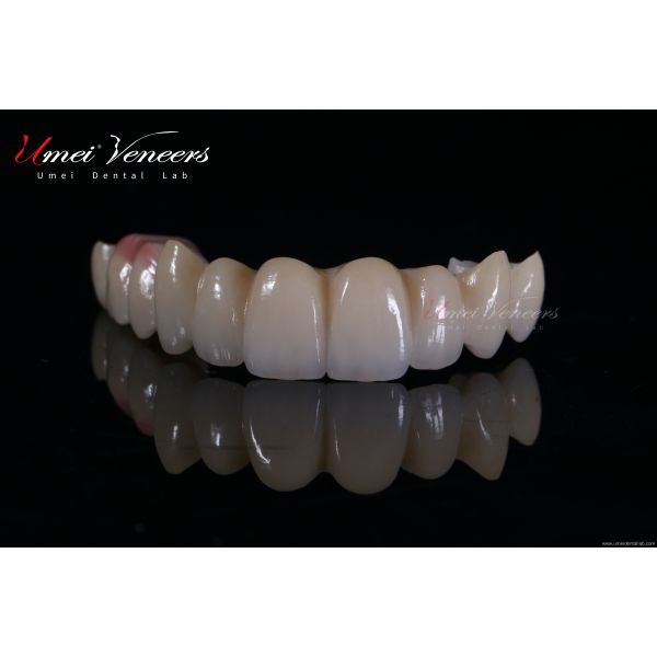 Natural Bright White Veneers