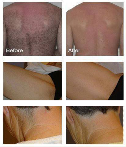 1064nm Laser Hair Removal Machine