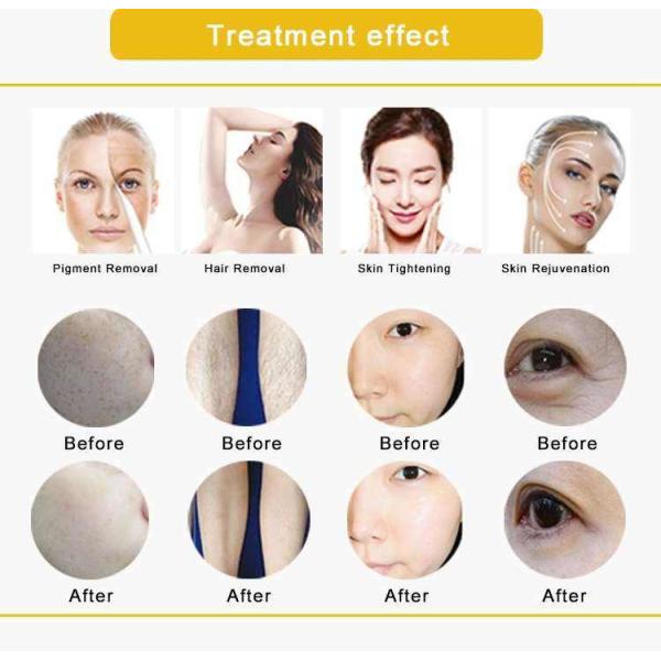 Portable IPL OPT Hair Removal Machine Permanent 300000~500000 Shots