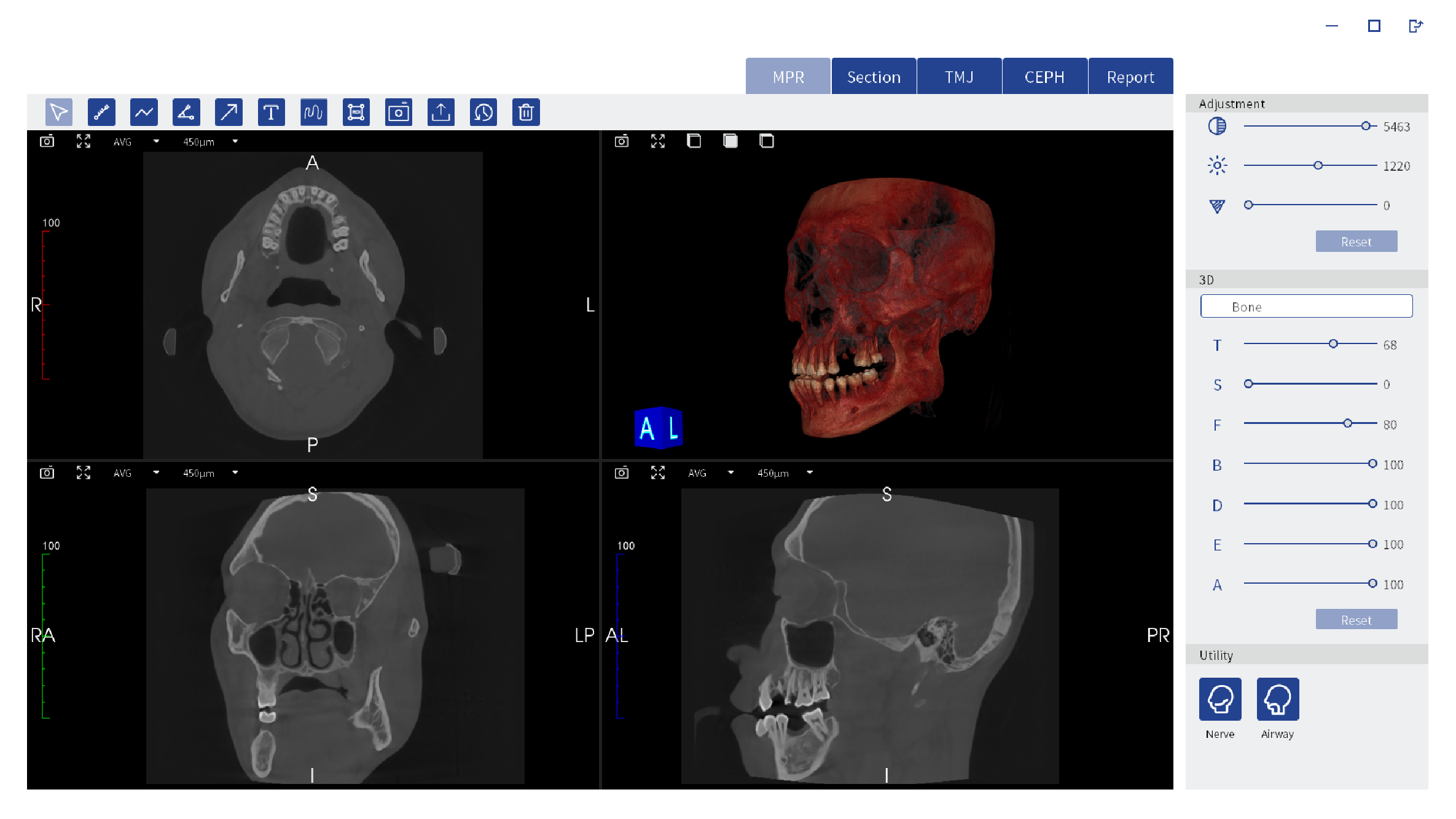 Dental Implant Orthodontic CBCT System High-Resolution 3D Imaging for Precise Diagnosis