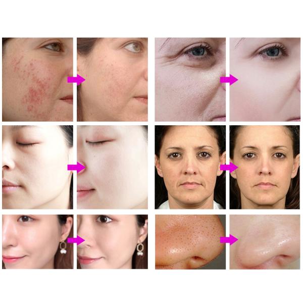 Aesthetic Oxygen Jet Aqua Peel Facial 7 in 1 Hydro Micro Dermabrasion Oxigen Hydra Microdermabrasion Beauty Machine