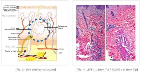 Fractional RF Microneedle For Wrinkle Removal / Skin Tightening