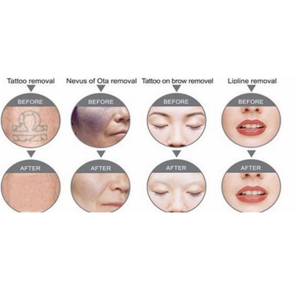 Effective 1000mj Q - Swich ND YAG Tattoo Laser Removal Machine With TUV