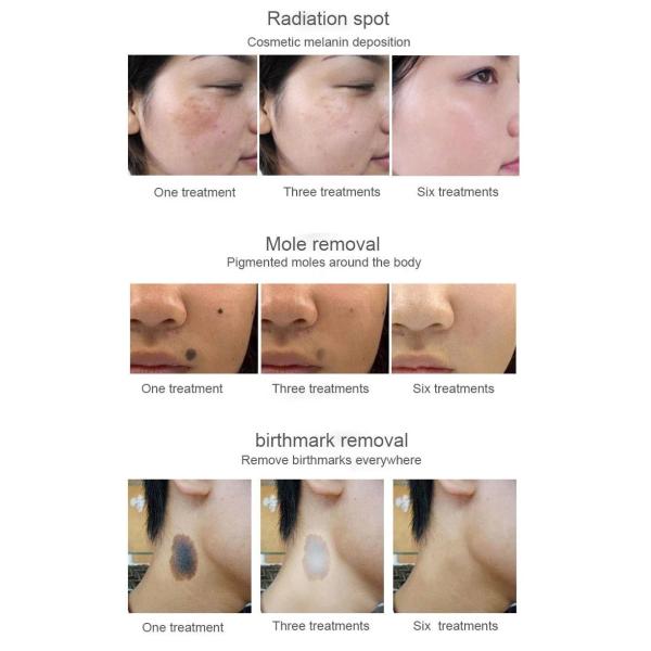 2000MJ q переключило лазер машины 1320nm портативный Picosure лазера Nd YAG