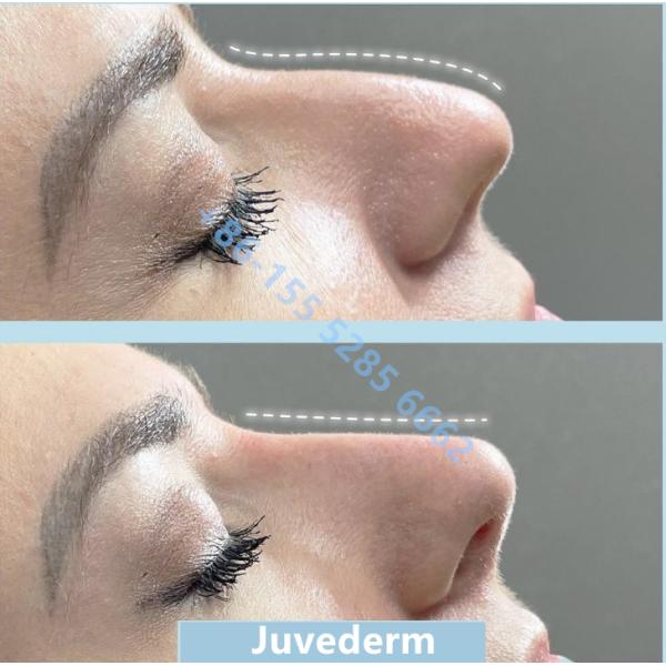 Juvederm Voluma Гиалуроновая кислота для лица 2*1 мл Инъекции