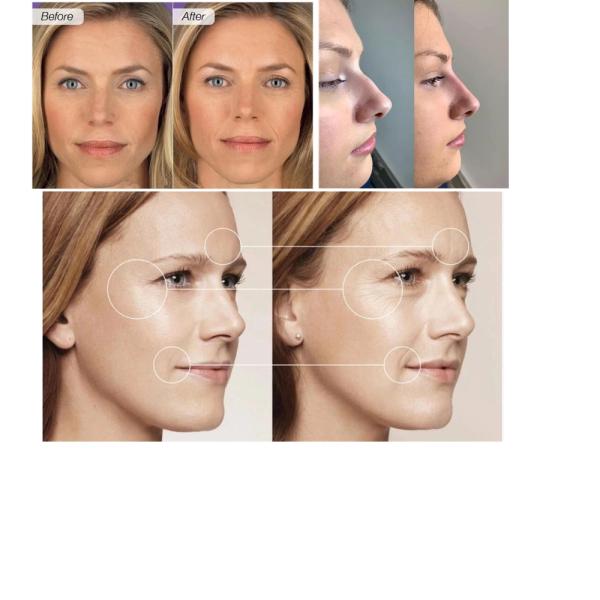 Медицинский заполнитель впрыски 1мл Неурамис губы Хялуроновой кислоты природного полимера для носа