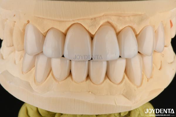 0.3-0.5mm Thick Feldspathic Porcelain Veneer High Fracture Resistance Upgrade Your Smile