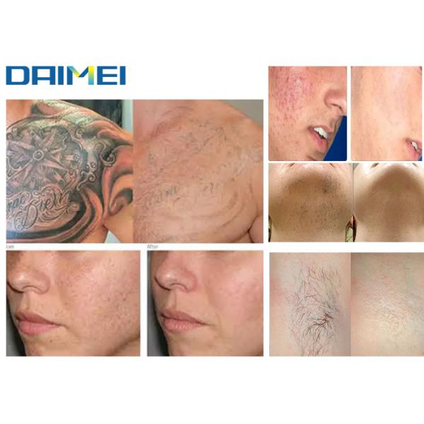 High Energy IPL Skin Rejuvenation Machine , E Light Laser Hair Removal Machine