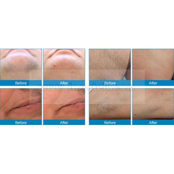 Вертикальная машина удаления волос лазера диода 808nm, оборудование лазера IPL пятна 13x13mm