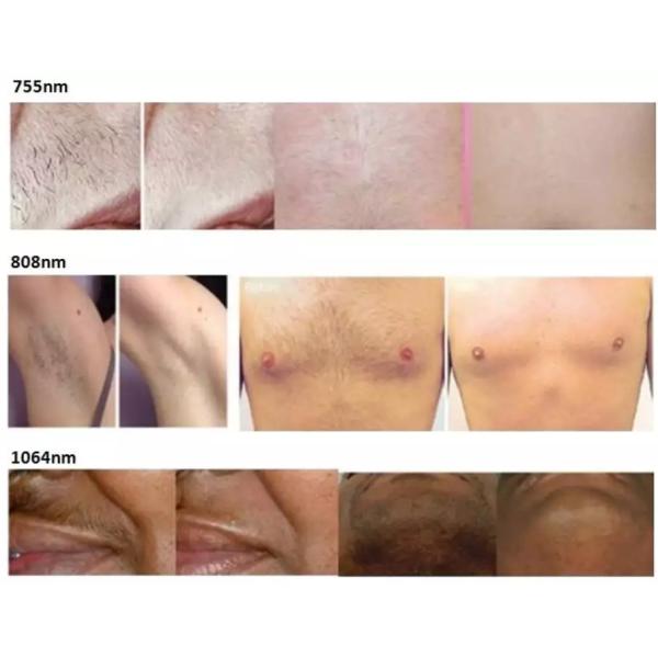 Лазерный тип диодный лазер 755nm 808nm 1064nm для домашнего мини ручной удаления волос