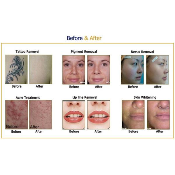 SHR IPL Portable ND YAG Laser Tattoo Removal Depilation Picosecond Laser Machine