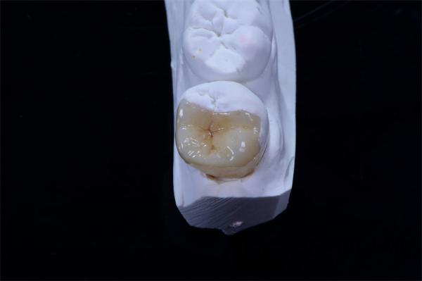 Dental Crown Composite Inlays And Onlays Restoration Customized Shape