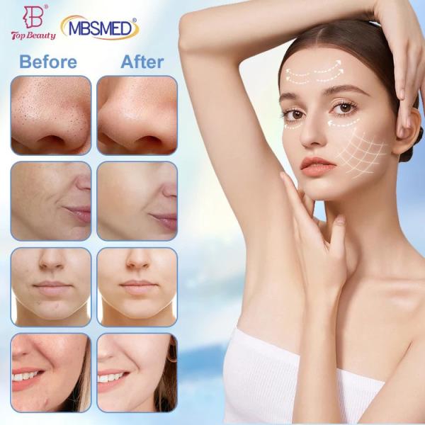 Hydro Oxygen Dermabrasion 6 In 1 Without Skin Analysis Microdermabrasion Machine