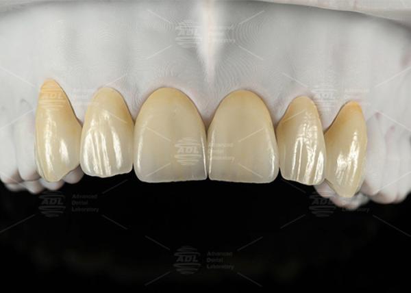 0.3mm-0.7mm Feldspathic EMAX Ceramic Veneers Natural Aesthetic Emax Dental Veneers