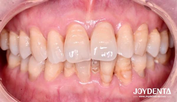 Zirconia dentures that imitate natural teeth