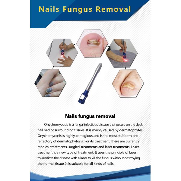 980nm Nail Fungus Removal Laser Machine Non Invasive Type Laser Treatment For Nail