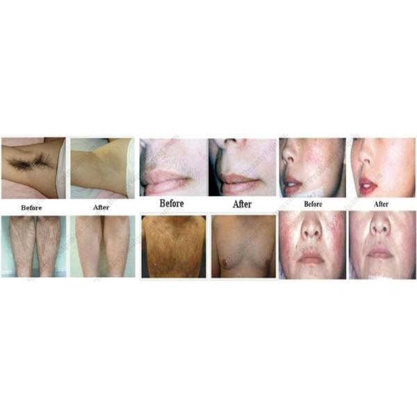 600 Watt 810nm Diode Laser Hair Removal Machine For Beauty Salon