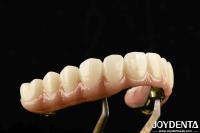 Puente híbrido de zirconia de barra de Ti fabricado con materiales de titanio y zirconia para uso pesado