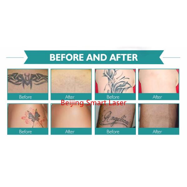 Mini Q Switch ND Yag Laser Tattoo Removal Machine