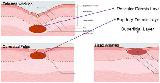 5mhz Touch High Quality Screen Thermage Skin Treatment Machine Nubway