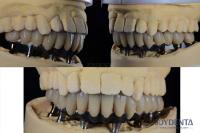 Titanium Multiple Teeth Dental Implant Prosthetic Surgery External Hexagon Connection