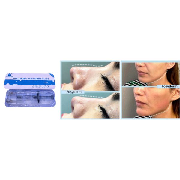 Fosyderm Hyaluronic Acid Facial Filler Dermal filler injection
