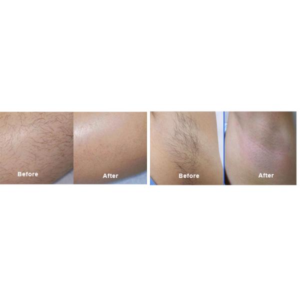 Permanent Diode Laser Hair Removal Machine 1-10hz Customized Language 1 Pulse