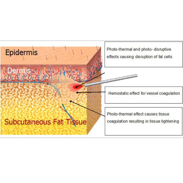 Skin Contraction Facial Laser Machine Equipment 1470nm 980nm