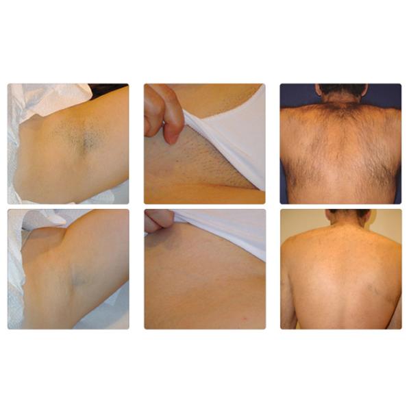 1200w Diode Laser Hair Removal Machine ,  Skin Hair Laser Removal Equipment