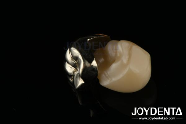 Oral Rehabilitation Wax Casting FMC Full Metal Crown For Dental Clinical Repair