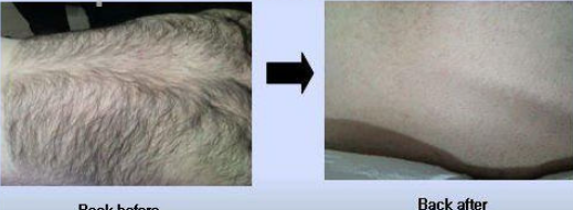 Semiconductor Laser Hair Removal Machine Skin Rejuvenation 600w 50 J/Cm2