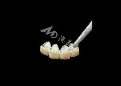 Porcelain Fused to Metal Crown with Enhanced Corrosion Resistance