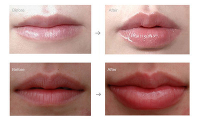 Применять обложку к заново родившийся заполнителю впрысок Хялуроник кислоты для ампулы Дерм 1-2мл морщинок